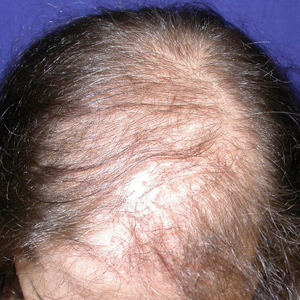 alopecia