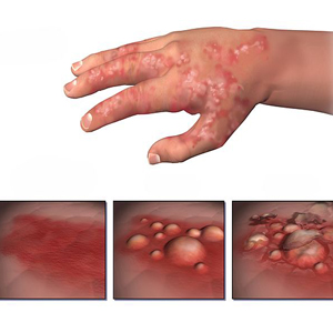 eczema