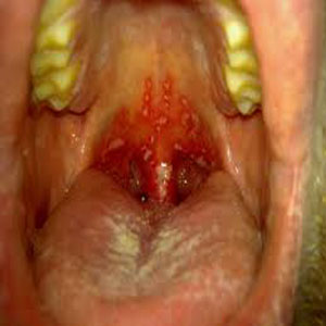 stomatitis